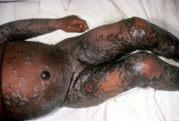 Smallpox Adverse Reaction Eczema Vaccinatum 2 A dark-skinned infant's torso and legs, covered in scabs and rash