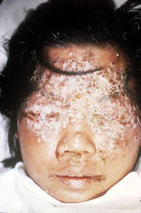 Smallpox Adverse Reaction Eczema Vaccinatum Ocular Damage A child's face covered in eczema vaccinatum scabs, particularly over the forehead and eyes