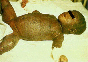 Smallpox Adverse Reaction Eczema Vaccinatum Unvaccinated Contact An infant lay on a bed, their torso, arms, legs, and head covered in rash and scabs