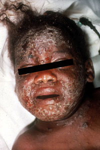 Smallpox Adverse Reaction Eczema Vaccinatum A small child with crusted scabs on their face