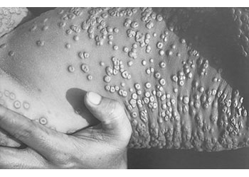 Smallpox Eruptive Stage A torso covered in smallpox lesions