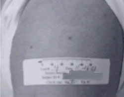 Vaccine Take Evaluation Erythema Nor Central Lesion An upper arm that has no erythema or central lesion after vaccination