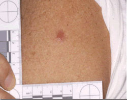 Vaccine Take Evaluation Erythema but No Central Lesion An upper arm with an erythema around the vaccination site