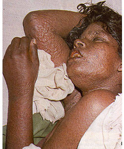 Flat-Type (Malignant) Smallpox A woman lies on a bed, covered in flat-type smallpox lesions