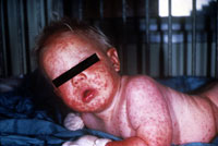 Smallpox Adverse Reaction Generalized Generalized Vacciniaaccinia An infant with a red rash all over