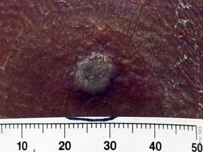 Smallpox Take Reaction Grayish Pustule Minimal Detectable Erythema A raised greyish lesion on dark skin