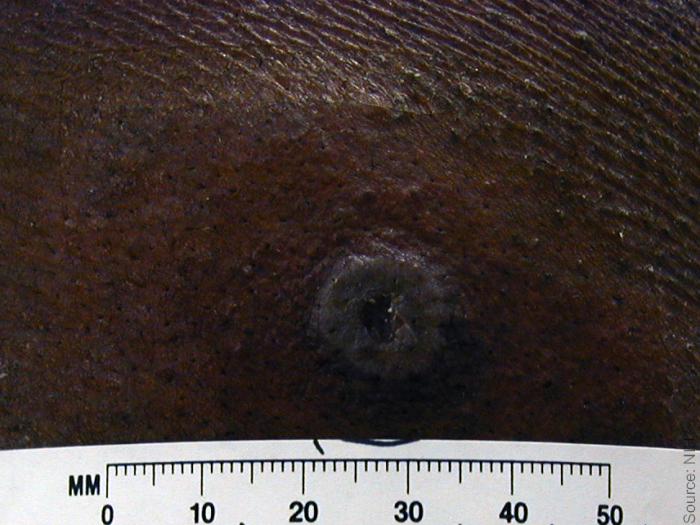 Smallpox Take Reaction Grayish Pustule A close up of a grayish pustule from smallpox vaccination on dark skin