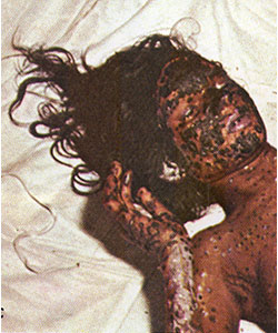 Hemorrhagic Smallpox A young woman lies on a bed, covered in bleeding smallpox pustules on her head, arm, hands, and chest.