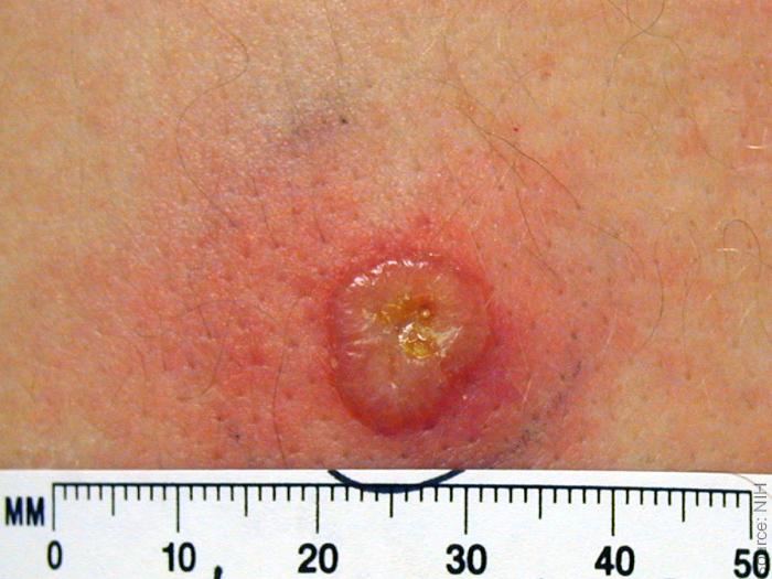 Smallpox Take Reaction Large Vesicle on Erythematous Base A red, raised pustule on light skin