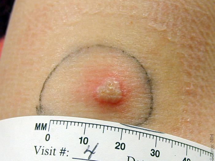 Smallpox Take Reaction Minimal Surrounding Erythema A whitish raised pustule on light skin