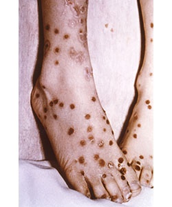 Modified-Type Smallpox Feet covered in smallpox lesions