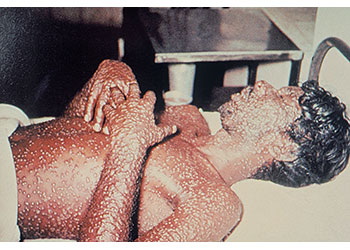 Clinical Ordinary Smallpox A male lies on a bed, covered in smallpox lesions