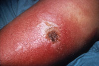 Smallpox Adverse Reaction Progressive Vaccinia Chronic Granulocytic Leukemia A close up of an arm, which is swollen, red, and has a large lesion