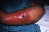 Smallpox Adverse Reaction Progressive Vaccinia A person holds up their arm, which is swollen and has a large, scabbing lesion
