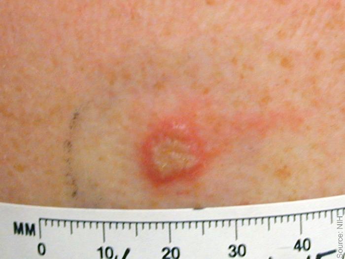 Smallpox Take Reaction Small Vesicle Minimal Erythema A small, raised lesion on light skin