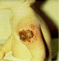 Smallpox Adverse Reaction Vaccinia Necrosum A small child with a large lesion on their arm