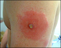 Robust Take A person's upper arm with a red rash around a smallpox vaccination site. A pustule is in the center.
