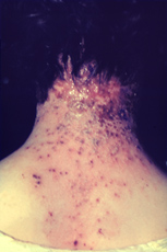 Eczema vaccinatum The back of a woman's neck, covered in a rash.