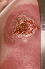 Progressive vaccinia An upper arm suffering from progressive vaccinia, where the skin around the vaccination site has become infected.