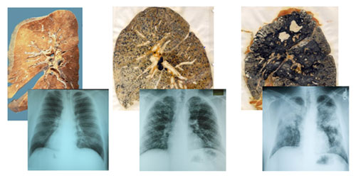 ConsecuenciasFig1 “Foto y radiografía de un pulmón normal (izquierda), con silicosis simple (centro) y con silicosis complicada (derecha). Los pulmones de las fotos son progresivamente más oscuros y los de las radiografías correspondientes muestran progresivamente mayor oclusión”.