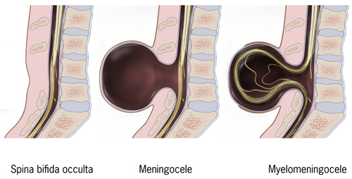typesofSpinabifida.jpg Shows the three most common types of spina bifida On the left is spina bifida occulta, in the middle is meningocele, and on the right is myelomeningocele.
