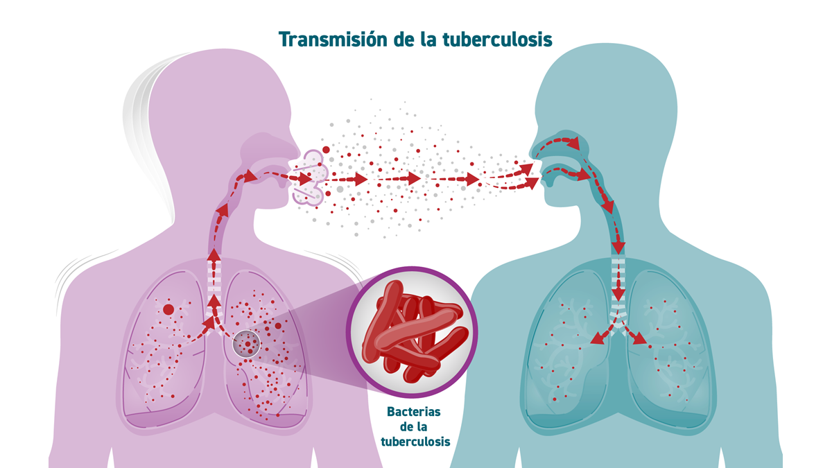 TB Transmission Spanish Un gráfico muestra los microbios de la tuberculosis propagándose de una persona a otra