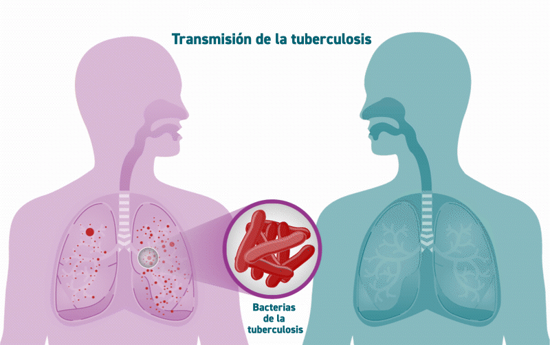 Tuberculosis Transmission Spanish Una animación muestra los microbios de la tuberculosis propagándose de una persona a otra.