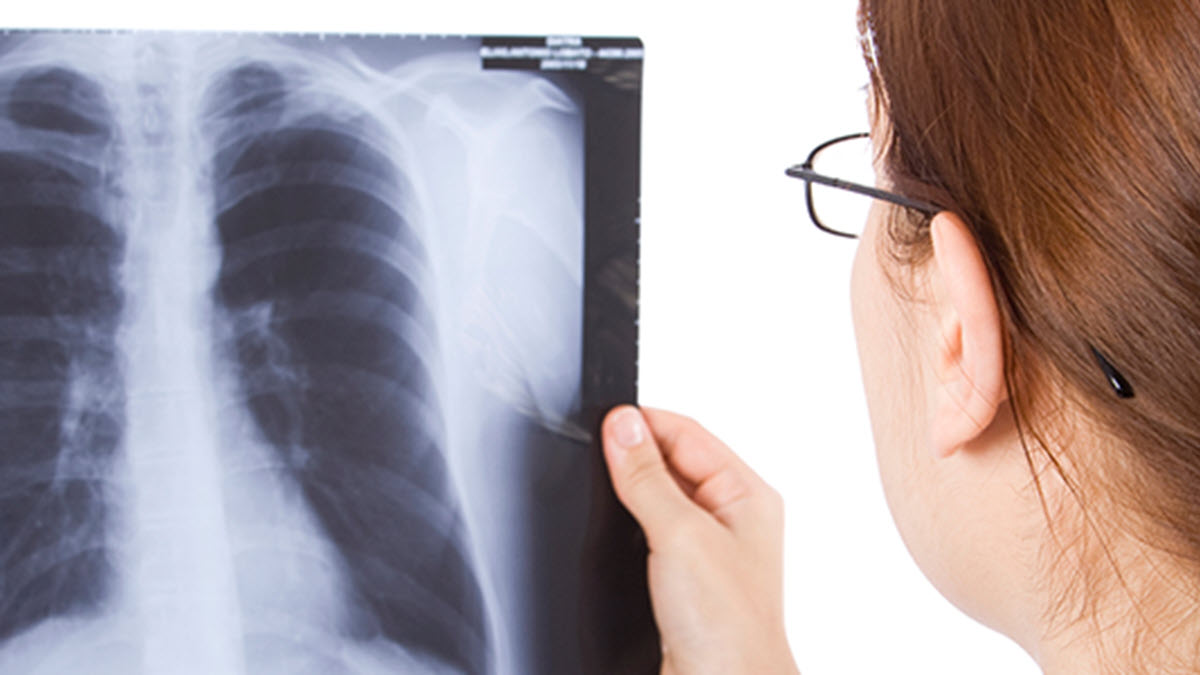 Doctor reviewing x-ray Doctor looking at a lung x-ray