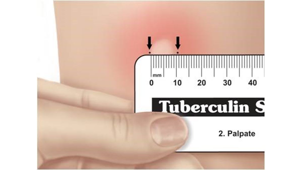 Reading the TB skin test A health care provider reads a TB skin test result