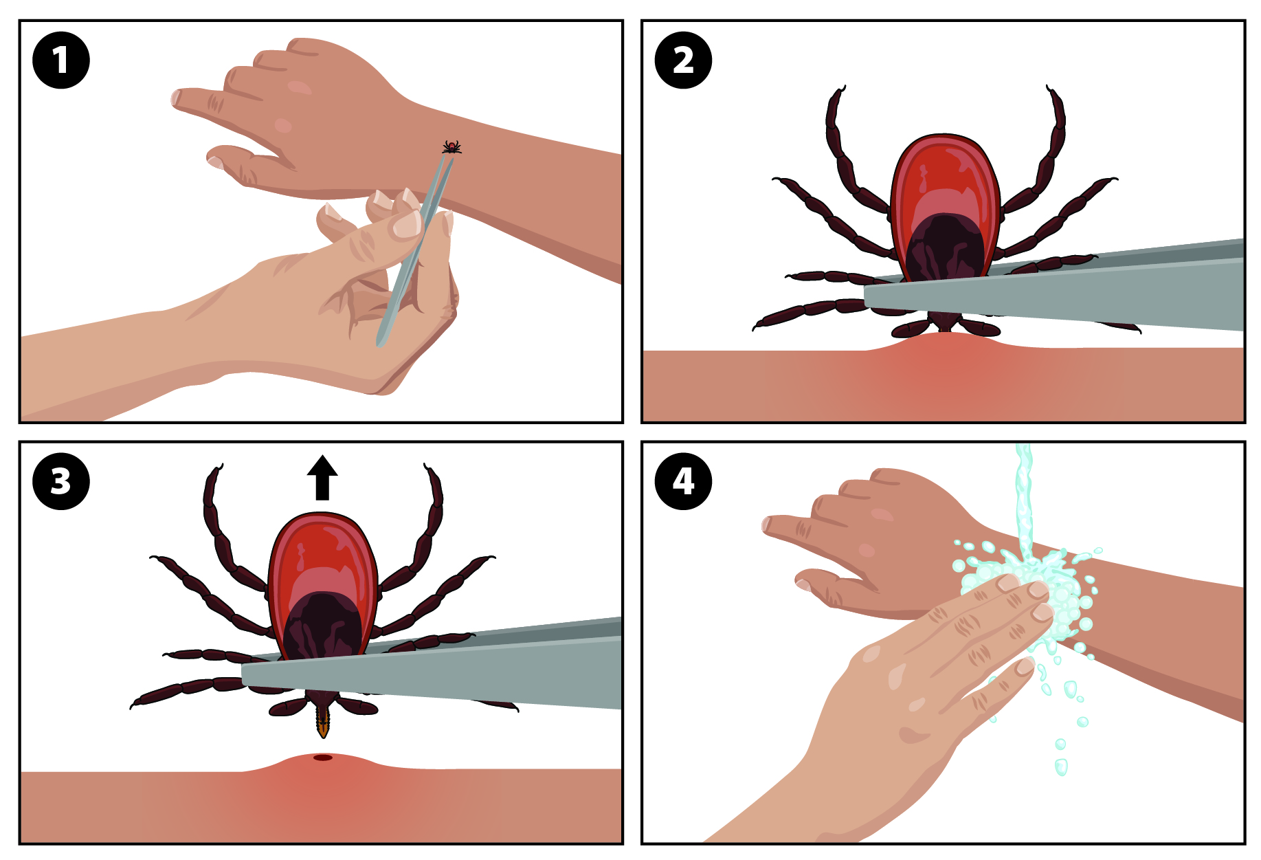 Illustration showing how to remove a tick with tweezers (Ixodes scapularis pictured).