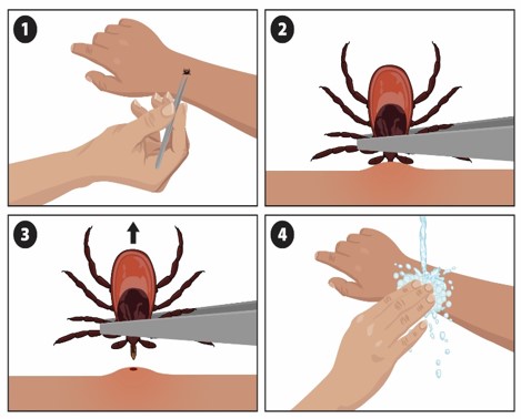ES Remove tick steps Ilustración que muestra cómo sacar una garrapata (imagen de Ixodes scapularis).