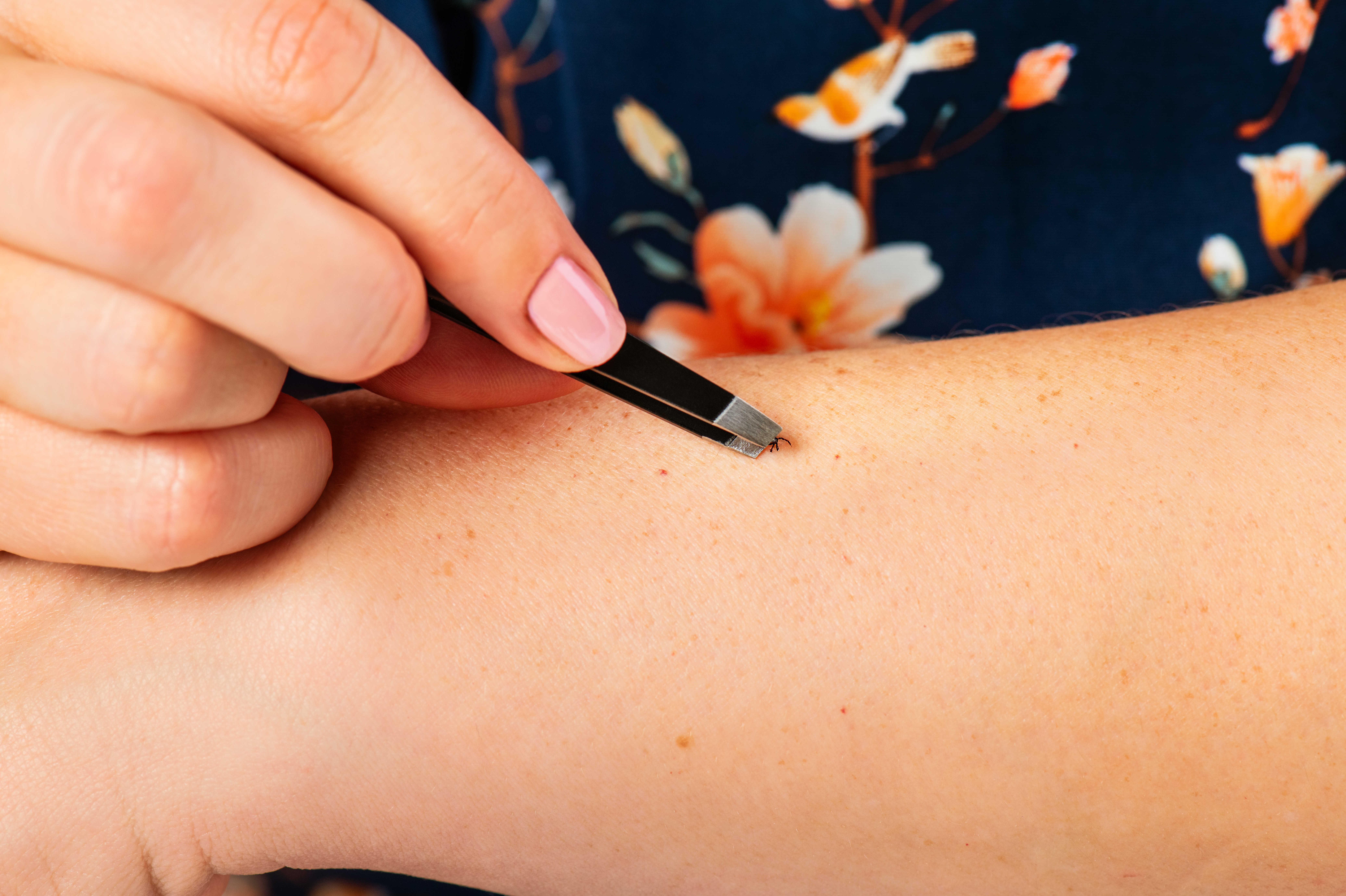 A woman grasping a tick attached to her arm with tweezers