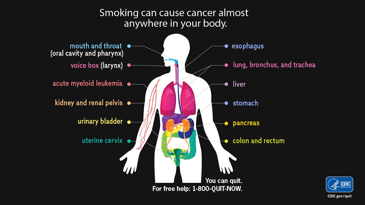 Health Effects: Smoking Can Cause Cancer Diagram of human body labeled with areas/organs that can develop smoking-related cancers.