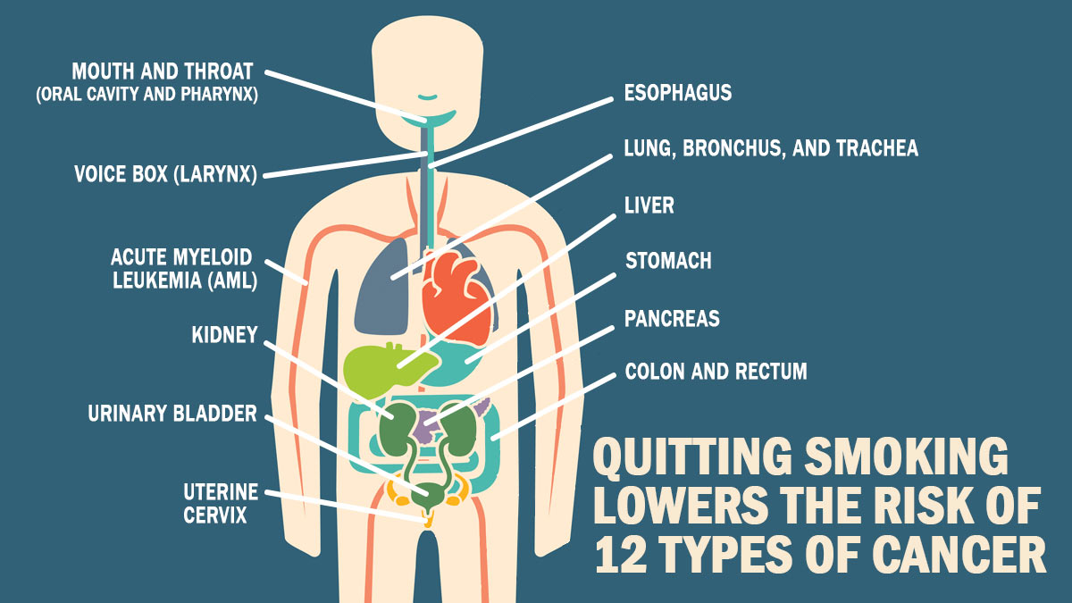 QUITTING SMOKING LOWERS THE RISK OF 12 TYPES OF CANCER Human body labeled with the 12 areas that cancer risk can be reduced by quitting smoking.