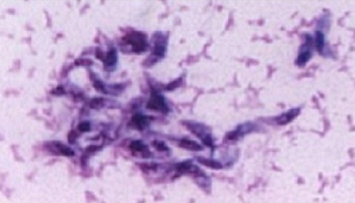 Toxoplasmosis