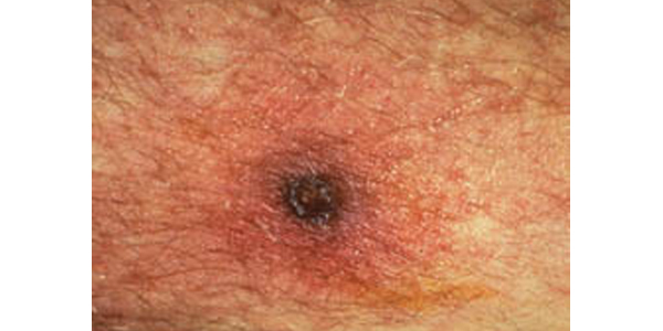Scrubtyphuseschar600x300 Eschar at site of chigger bite