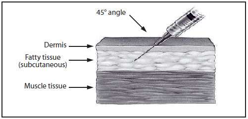 admin-fig-5.jpg This drawing shows subcutaneous needle insertion into a cross-section of skin. The needle is inserted at a 45-degree angle and penetrates the dermis and fatty tissue (subcutaneous) but not the muscle tissue.