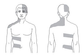 Shingles VIS illustration Line drawing of a male figure shown from the front and back, highlighting horizontal bands on the torso and back.