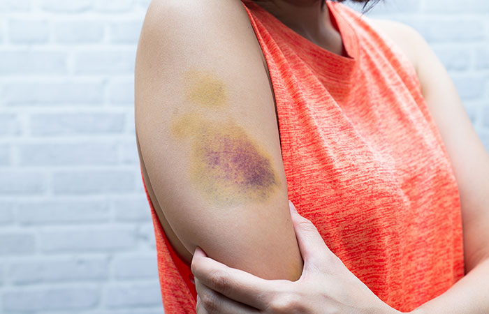 Woman holding her arm that has a large purple and yellow bruise on it