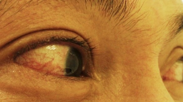 — title missing — Picture of a person's eyes with conjunctivitis (red eyes).